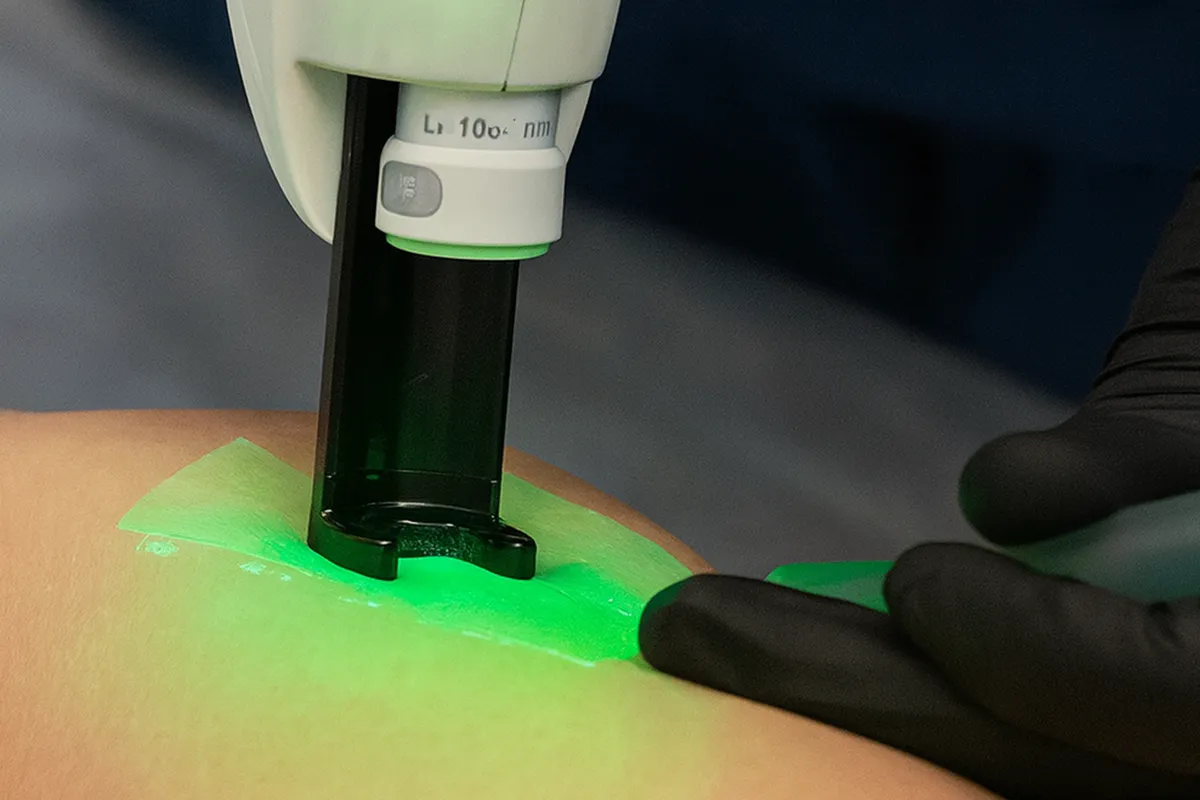 Crio laser com escleroteraía